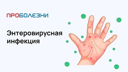 Энтеровирусная инфекция. Важно знать!