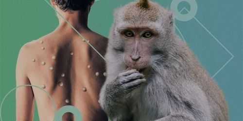 Мартышка и оспа: «Лапша» развеяла мифы об известном заболевании