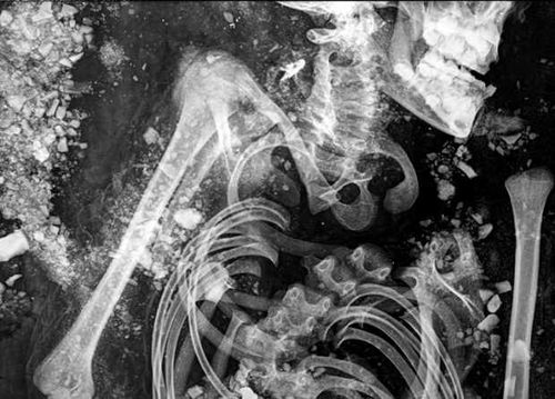 Дети скифов болели рахитом