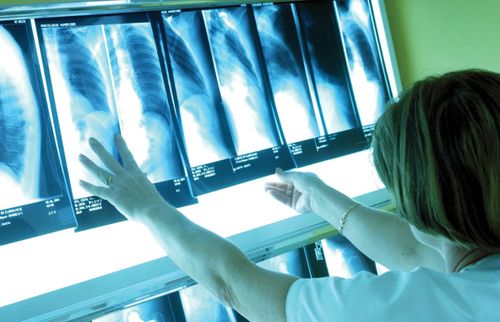 Туберкулез в Туве: рост заболеваемости в 10 муниципалитетах