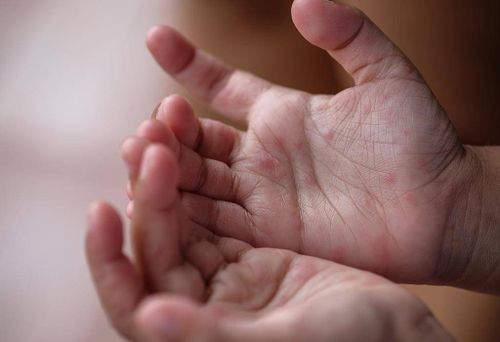 В Туве зафиксировано 63 случая энтеровирусной инфекции и один - энтеровирусного менингита