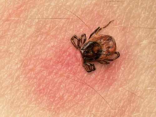 В Туве 30 несовершеннолетних обратились к медикам из-за присасывания клещей