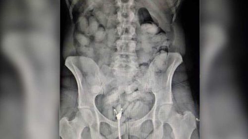 Наркодилер попытался пронести наркотики в желудке